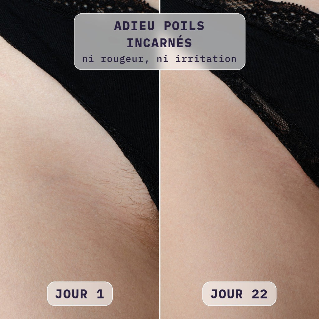 Avant / après épilation du maillot à la lumière pulsée Bodysiam, sans poils incarnés