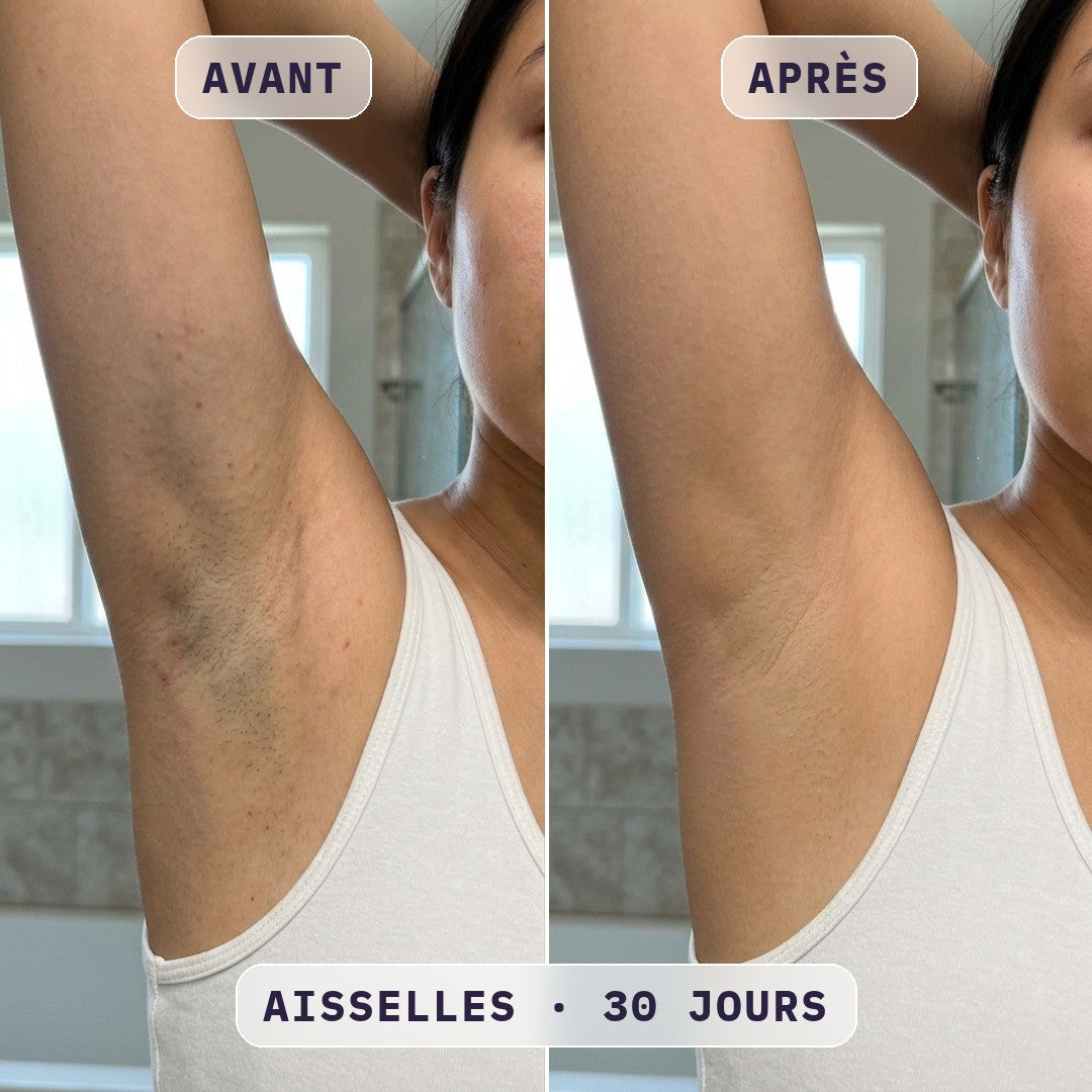 Avant / après épilation à la lumière pulsée Bodysiam, photo cliente