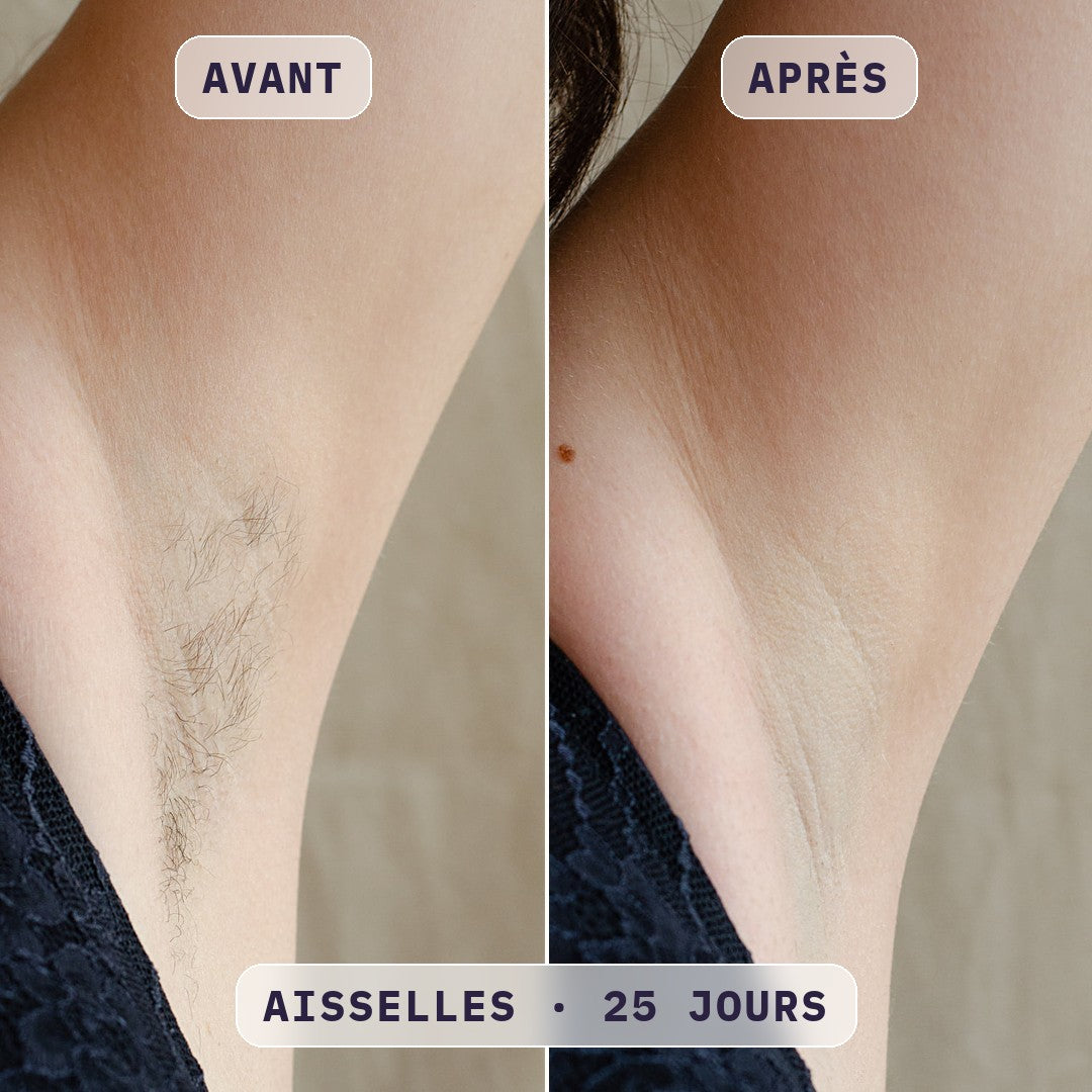 Avant / après épilation à la lumière pulsée Bodysiam