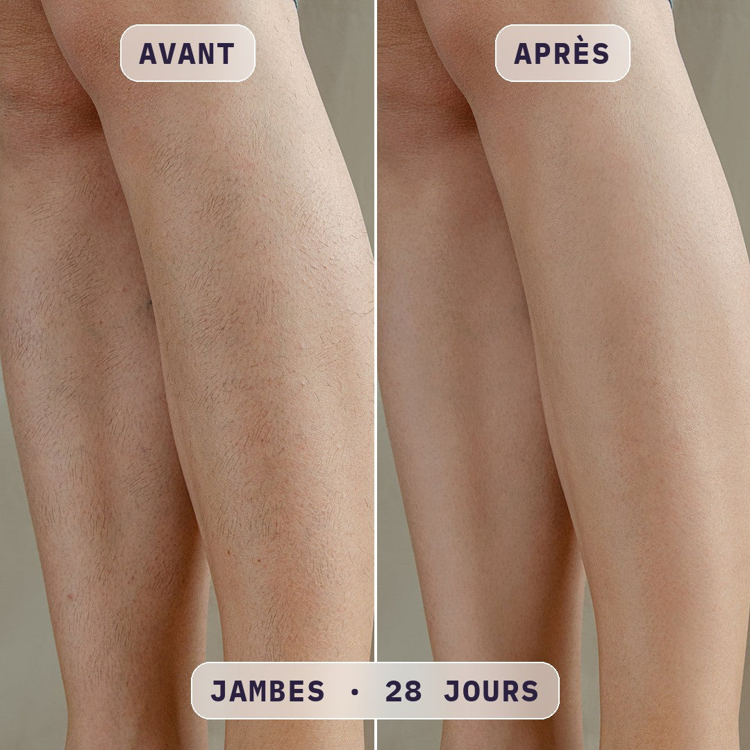 Avant / après épilation à la lumière pulsée Bodysiam