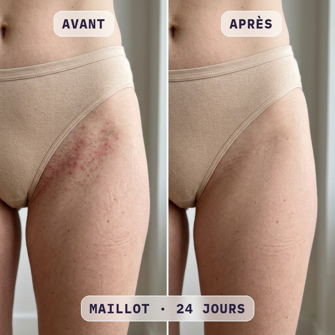 Avant / après épilation à la lumière pulsée Bodysiam, photo cliente
