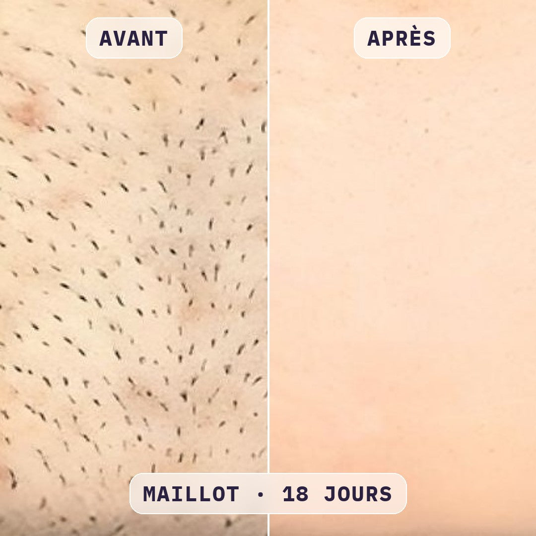 Avant / après épilation du maillot à la lumière pulsée Bodysiam, sans poils incarnés, photo cliente