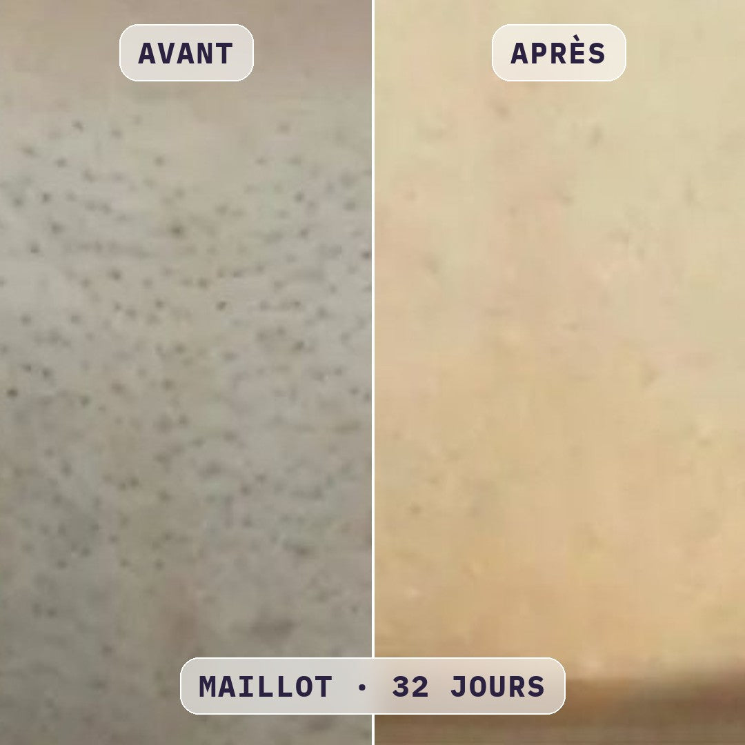 Avant / après épilation du maillot à la lumière pulsée Bodysiam, sans poils incarnés, photo cliente