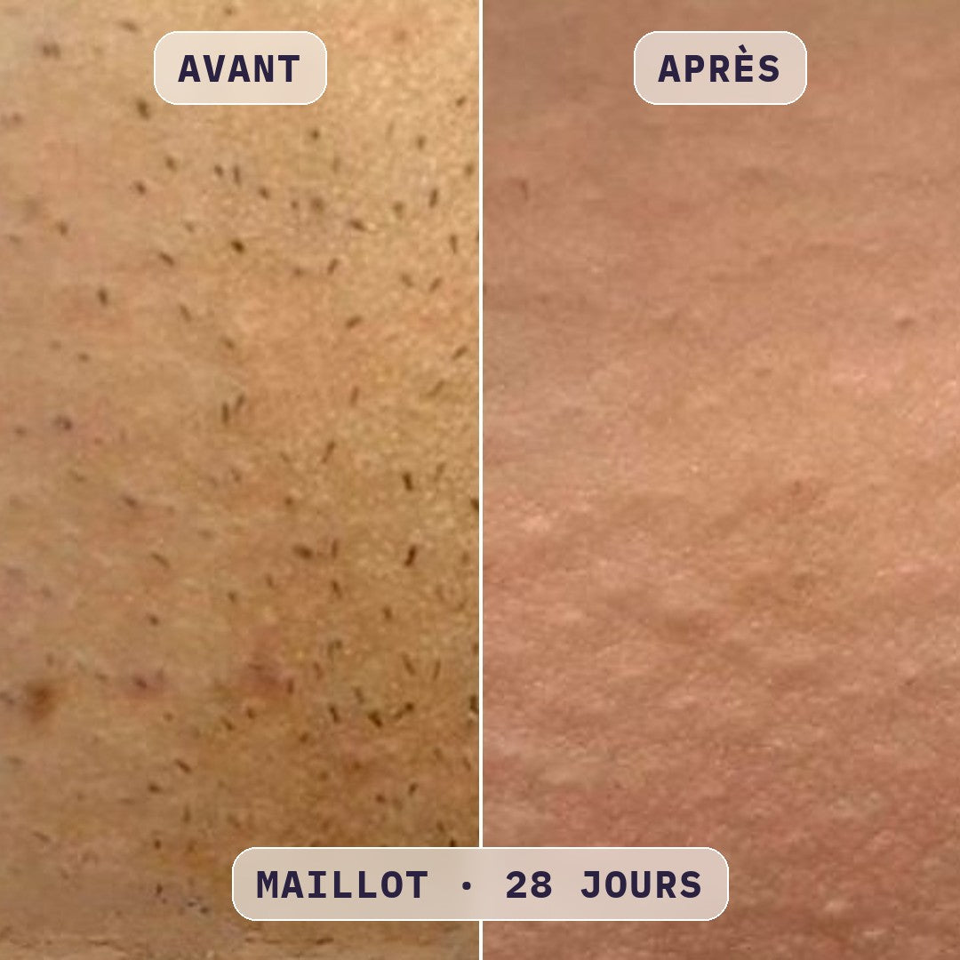 Avant / après épilation du maillot à la lumière pulsée Bodysiam, sans poils incarnés, photo cliente
