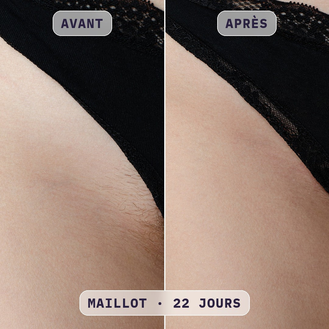 Avant / après épilation à la lumière pulsée Bodysiam