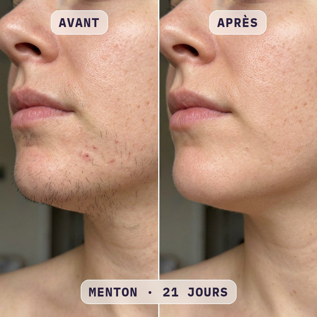 Avant / après épilation à la lumière pulsée Bodysiam, photo cliente