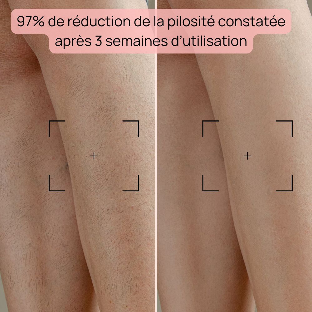 Epilateur Lumiere Pulsée - Bodysiam Skin Expert Lite