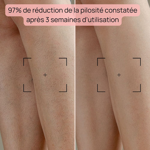 Epilateur Lumiere Pulsée - Bodysiam Skin Expert Lite
