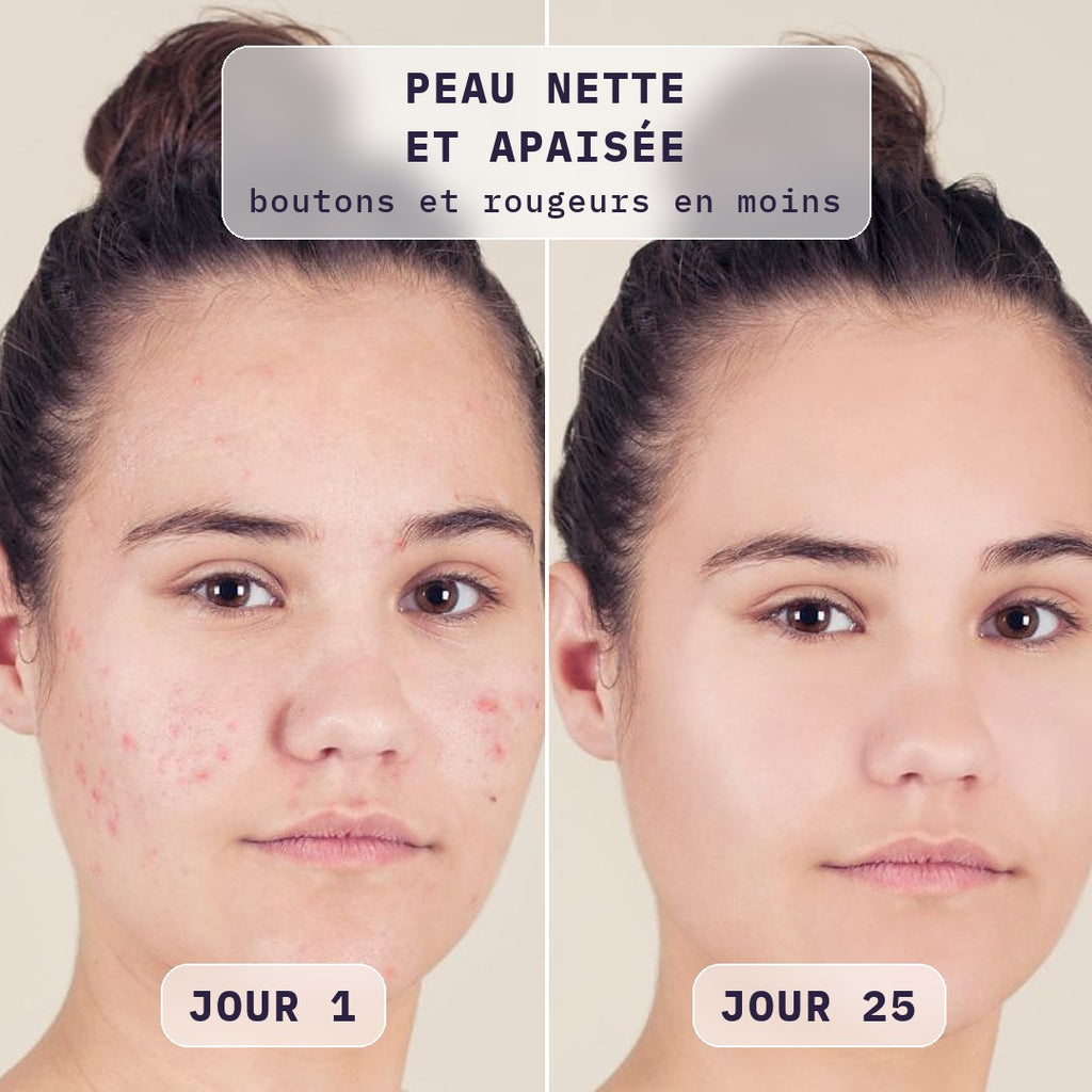 Avant / après masque LED visage Bodysiam sur l'acné, jour 1 et jour 25