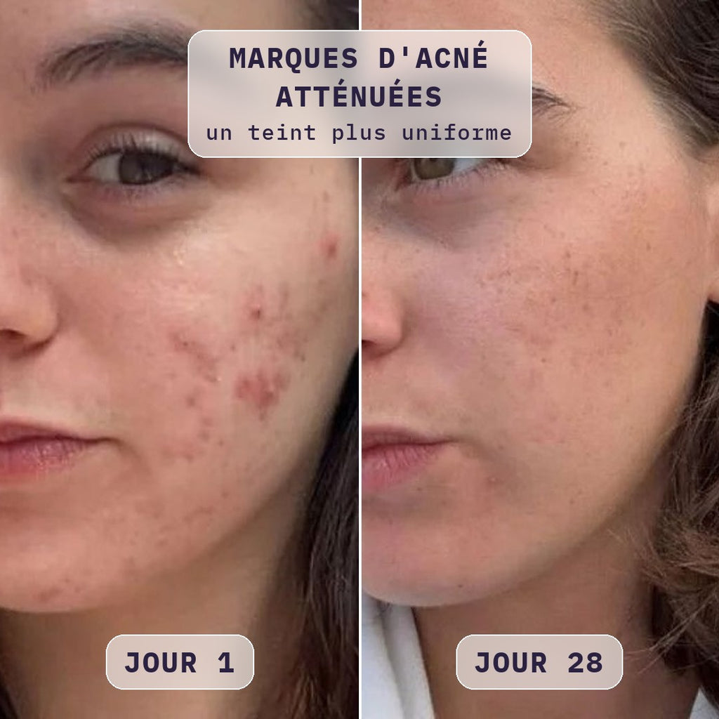 Avant / après masque LED visage Bodysiam sur les marques d'acné, jour 1 et jour 28
