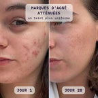 Avant / après masque LED visage Bodysiam sur les marques d'acné, jour 1 et jour 28