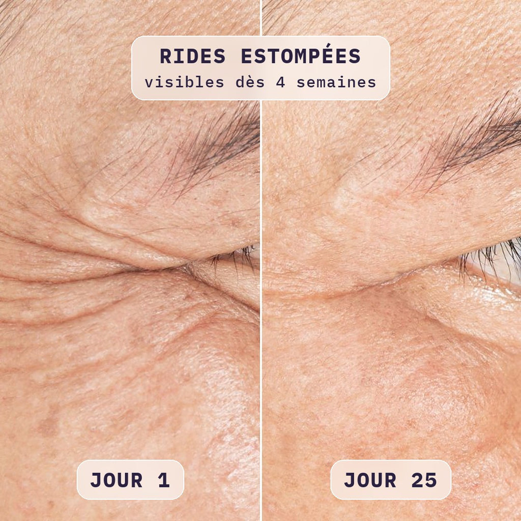 Avant / après masque LED visage Bodysiam sur la patte d'oie, jour 1 et jour 25
