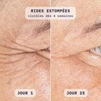 Avant / après masque LED visage Bodysiam sur la patte d'oie, jour 1 et jour 25