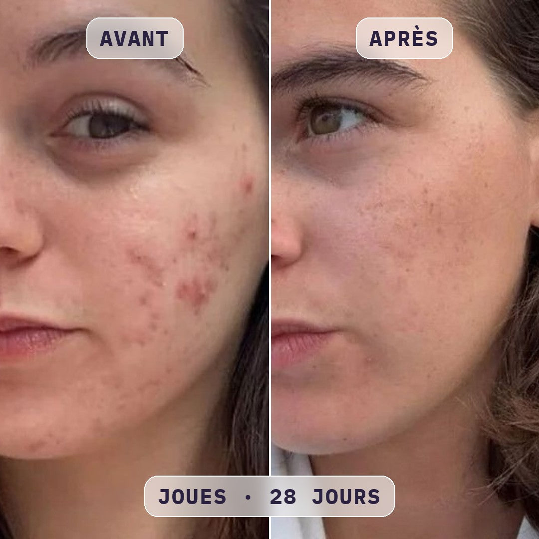 Avant / après masque LED visage Bodysiam, photo cliente
