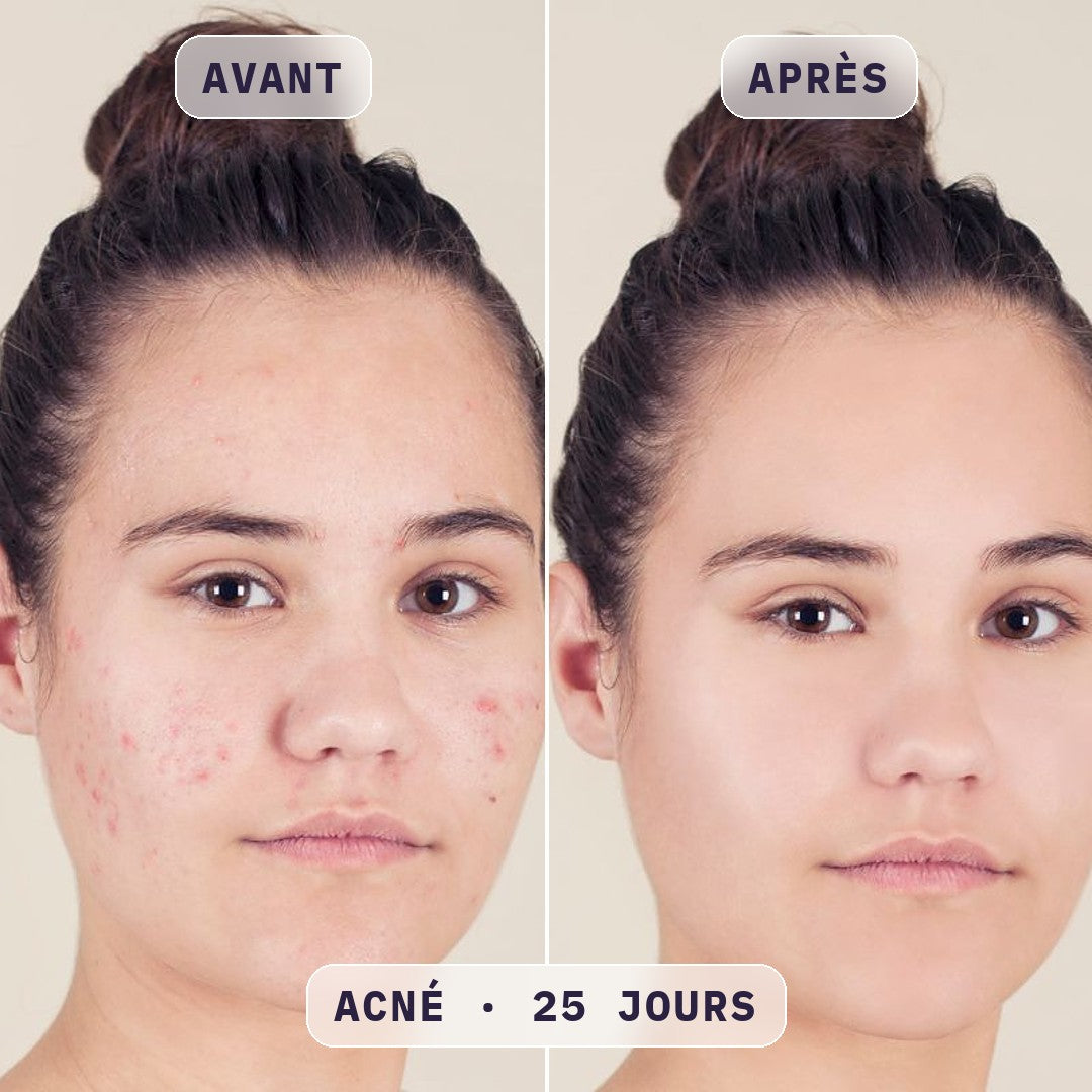 Avant / après masque LED visage Bodysiam, photo cliente