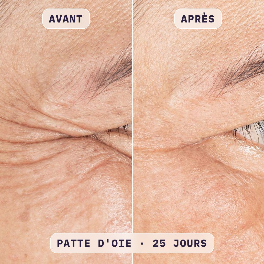 Avant / après masque LED visage Bodysiam, photo cliente