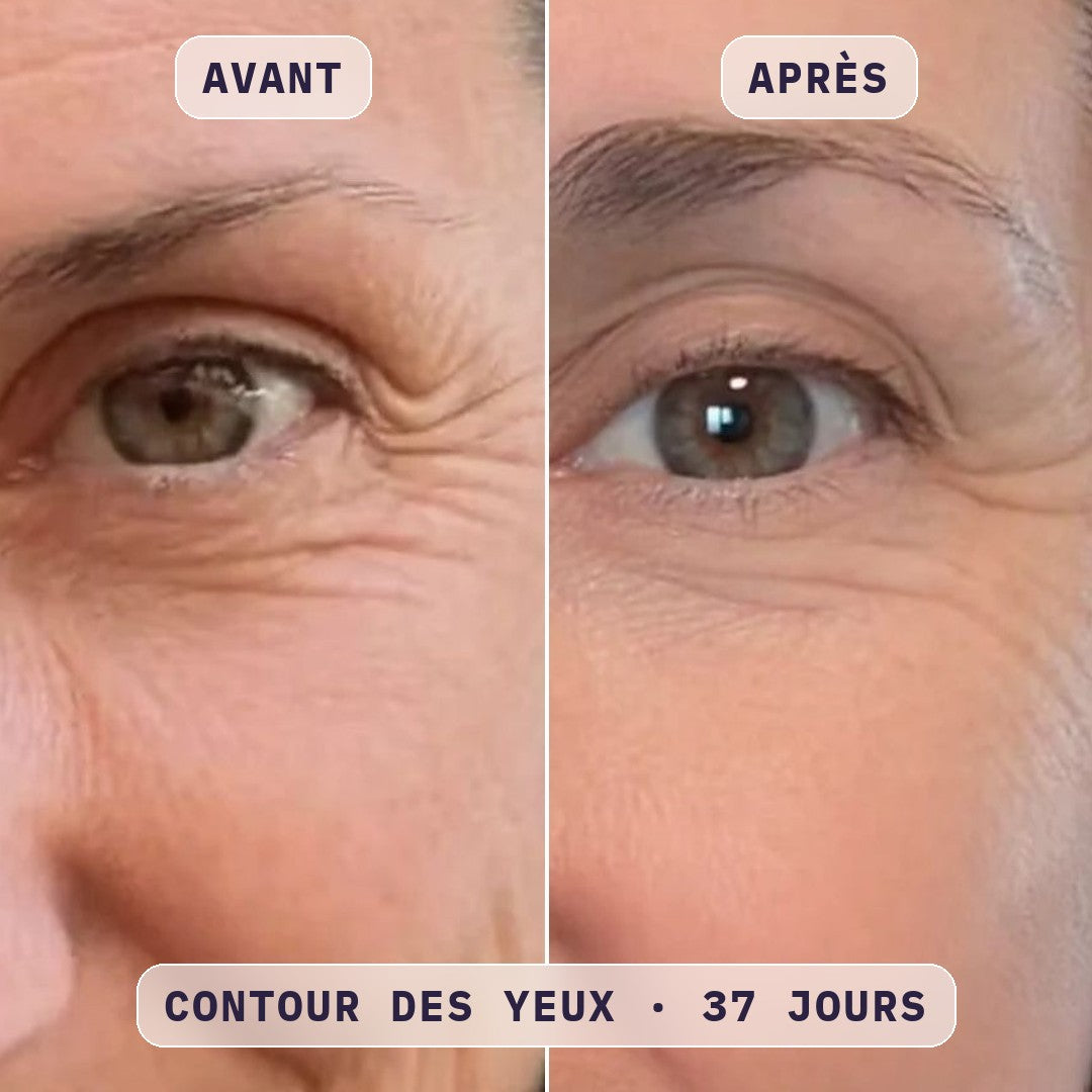 Avant / après masque LED visage Bodysiam, photo cliente